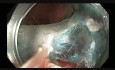 Kolonoskopia - odbytnica - EMR dużego polipa