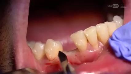 Wymiana nieudanego mostu protetycznego opartego na implantach.