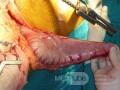 Gruczolakorak wpustu i dna żołądka z komórkami sygnetowatymi (6 z 25)
