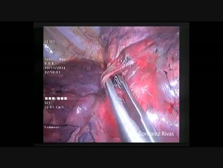 Segmentektomia S2 płata górnego płuca prawego techniką VATS 