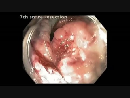 Endoskopowa resekcja śluzówkowa olbrzymiego siedzącego polipa w okrężnicy wstępującej