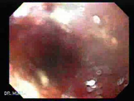 Przełyk Barretta i gruczolakorak połączenia żołądkowo-przełykowego - ablacja przezendoskopowa