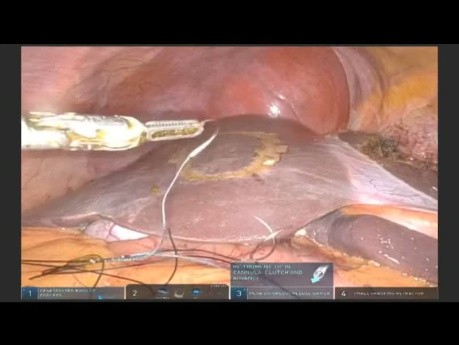 Subsegmentowa miąższowa resekcja oszczędzająca, w przypadku przerzutowego raka jelita grubego, z użyciem robota