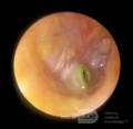 Ostre zapalenie ucha środkowego z wprowadzoną rurką wentylacyjną