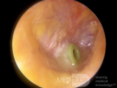Ostre zapalenie ucha środkowego z wprowadzoną rurką wentylacyjną