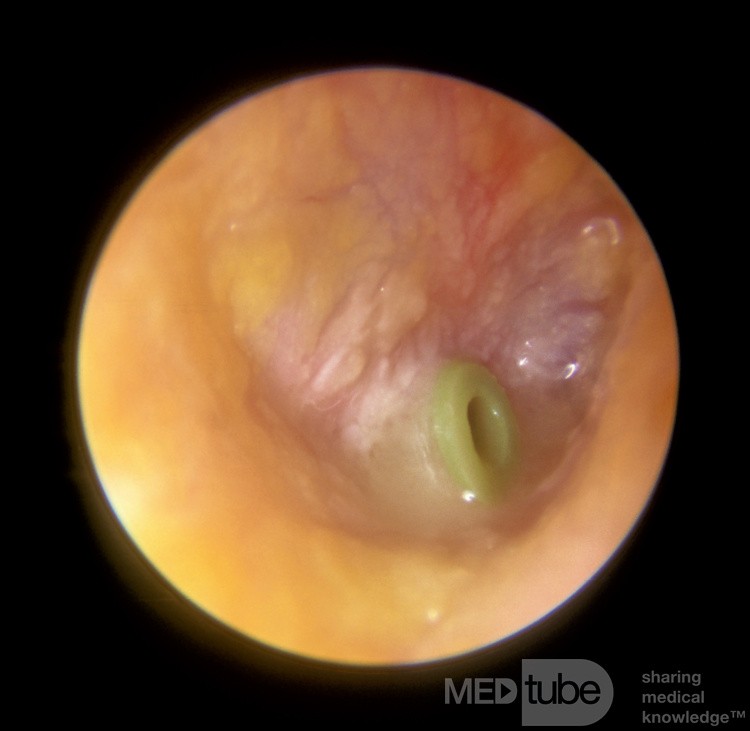 Ostre zapalenie ucha środkowego z wprowadzoną rurką wentylacyjną