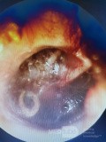 Ostre zapalenie ucha środkowego - endoskopia