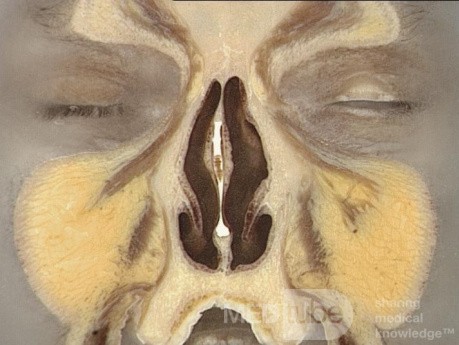 Anatomia nosa i zatok przynosowych w przekroju czołowym - przekrój 3