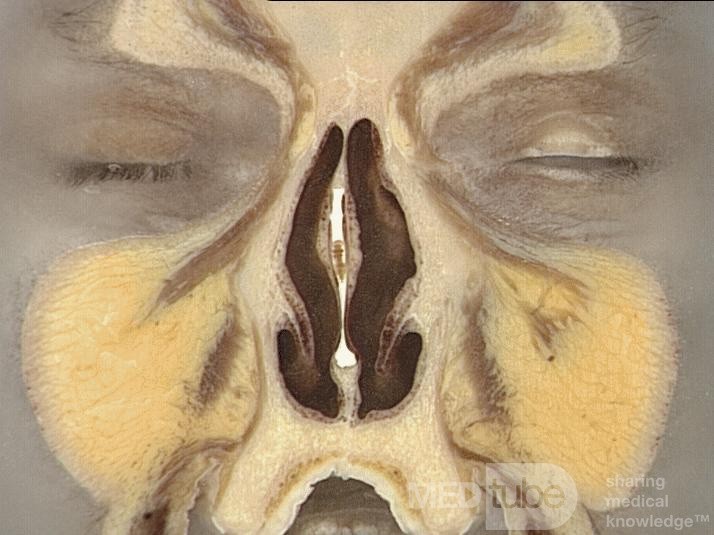 Anatomia nosa i zatok przynosowych w przekroju czołowym - przekrój 3
