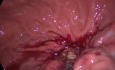 Nekrozektomia laparoskopowa z dostępu przez żołądek