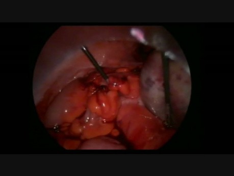 Laparoskopia z powodu skrętu jajnika z cystą