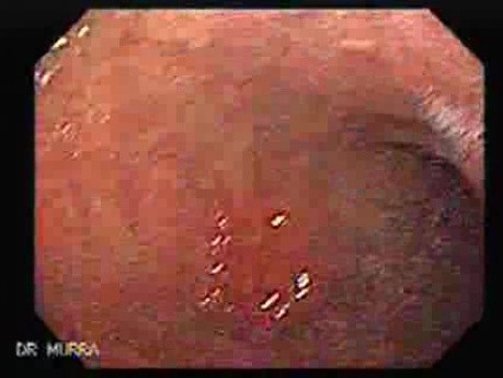 Gruczolakorak żołądka - wczesne stadium - endoskopia (3 z 5)