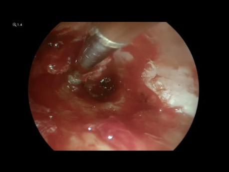 Endoskopowa tympanoplastyka rewizyjna