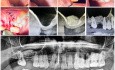 Podniesienie dna zatoki szczękowej z augumentacją – I ćwiartka
