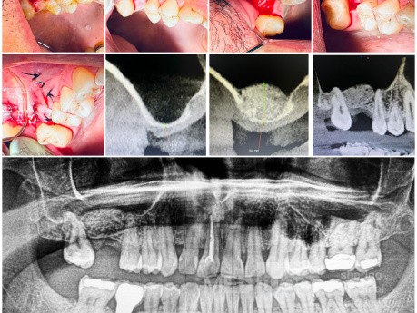 Podniesienie dna zatoki szczękowej z augumentacją – I ćwiartka