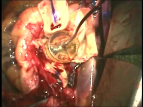 Jak wykonać operację wymiany pnia aorty?