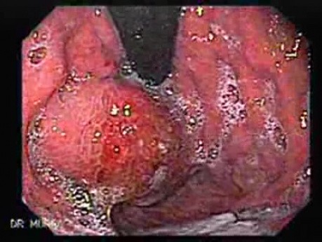 Żylaki żołądka - endoskopowa ablacja klejem cyjanoakrylowym (12 z 18)