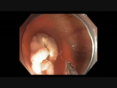 Kolonoskopia: zamykanie ubytków po endoskopowej resekcji śluzówkowej 3