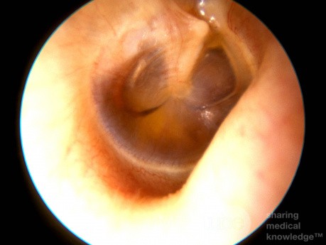 Surowiczego zapalanie ucha środkowego - menisk płynu z powietrzem
