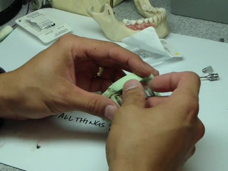 Most na implantach nie pasuje – i jak to obejść