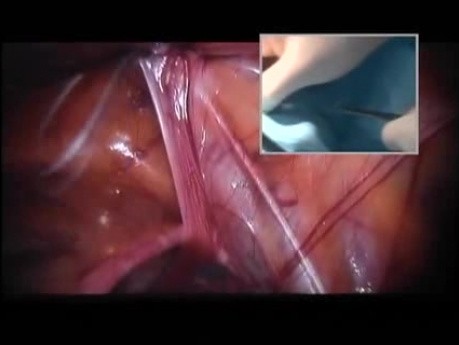 Laparoskopowa operacja obustronnej przepukliny pachwinowej u dziewczynki