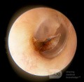 Strup w błonie bębenkowej po ostrym zapaleniu ucha środkowego