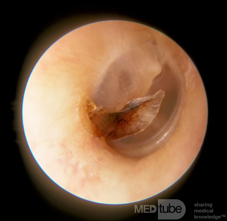 Strup w błonie bębenkowej po ostrym zapaleniu ucha środkowego