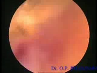 Przezszyjkowa resekcja mięśniaka macicy