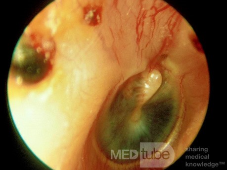 Zapalenie pęcherzowe błony bębenkowej z krwią  w uchu środkowym