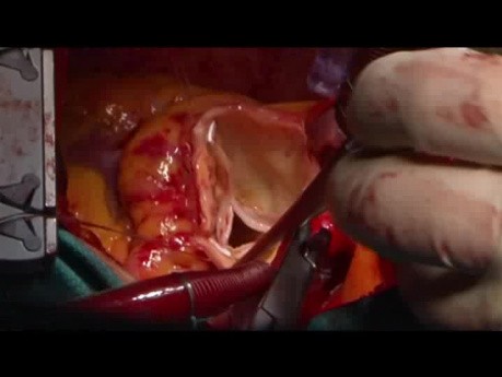 Rekonstrukcja opuszki i aorty wstępującej