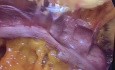Funduplicatura de Dor deslizada hacia mediastino (hernia Hiatal tipo III)