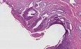Metaplazja nabłonka płaskiego, rak in situ - histopatologia - szyjka macicy