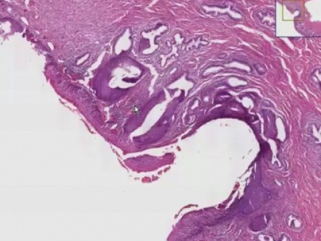 Metaplazja nabłonka płaskiego, rak in situ - histopatologia - szyjka macicy