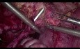 Laparoskopowa reimplantacja moczowodowo-pęcherzowa