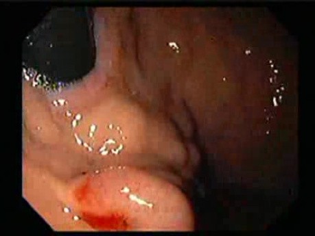 Żylaki żołądka - endoskopowa ablacja klejem cyjanoakrylowym (3 z 18)