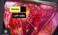Endometrioza nerwu zasłonowego leczona peritonektomią