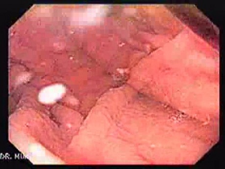 Fałdy żołądka - endoskopia powiększająca (1 z 8)