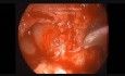 Tympanomastoidektomia endoskopowa