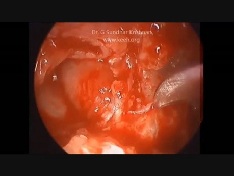 Tympanomastoidektomia endoskopowa