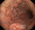 Nietypowy obraz polipów dna i trzonu żołądka w endoskopii. Chromoendoskopia. NET (1/6)