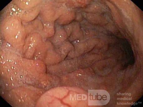 Nietypowy obraz polipów dna i trzonu żołądka w endoskopii. Chromoendoskopia. NET (1/6)