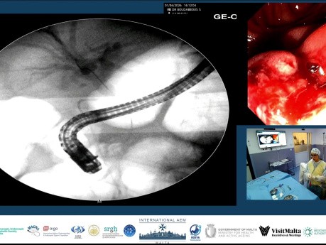 Chirurg pozostawił dren. My założyliśmy stent.