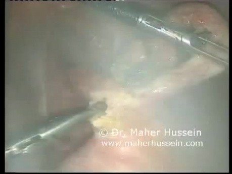 Appendektomia laparoskopowa