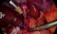 Cholecystektomia laparoskopowa z uniknięciem powikłań z PŻW