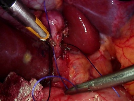 Cholecystektomia laparoskopowa z uniknięciem powikłań z PŻW