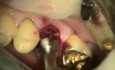 Natychmiastowa implantacja trzonowca z wykorzystaniem systemu Max Dental