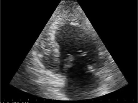 Echokardiograficzny quiz - czy lewa komora jest prawidłowa? Obraz koniuszkowy