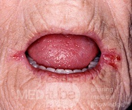 Zapalenie kącików ust