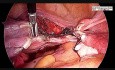 Bezpieczny sposób na przeprowadzenie całkowitej laparoskopowej histerektomii z obustronną resekcją przydatków