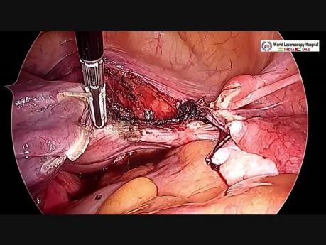 Bezpieczny sposób na przeprowadzenie całkowitej laparoskopowej histerektomii z obustronną resekcją przydatków